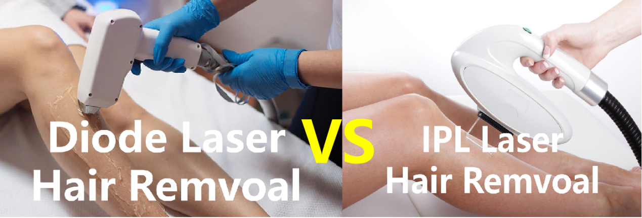 ÉPILATION AU LASER IPL VS DIODE