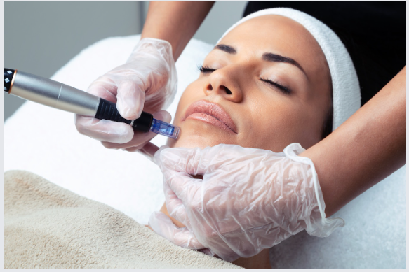 Quelles sont les différences entre le microneedling et la mésothérapie ?