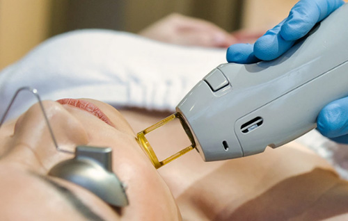 Pourquoi de plus en plus de clients choisissent le laser AlexandRite pour faire la épilation?