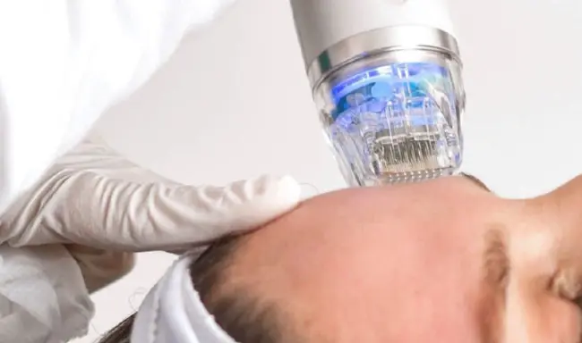 Quels sont les avantages du traitement par microneedling RF ?