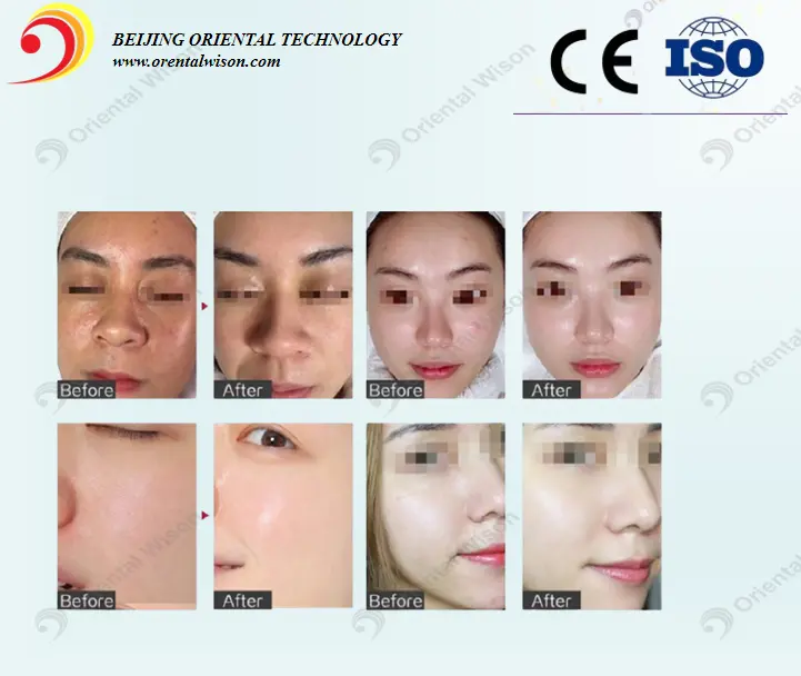 Mesotherapy Gun Skin Wrinkle Removal