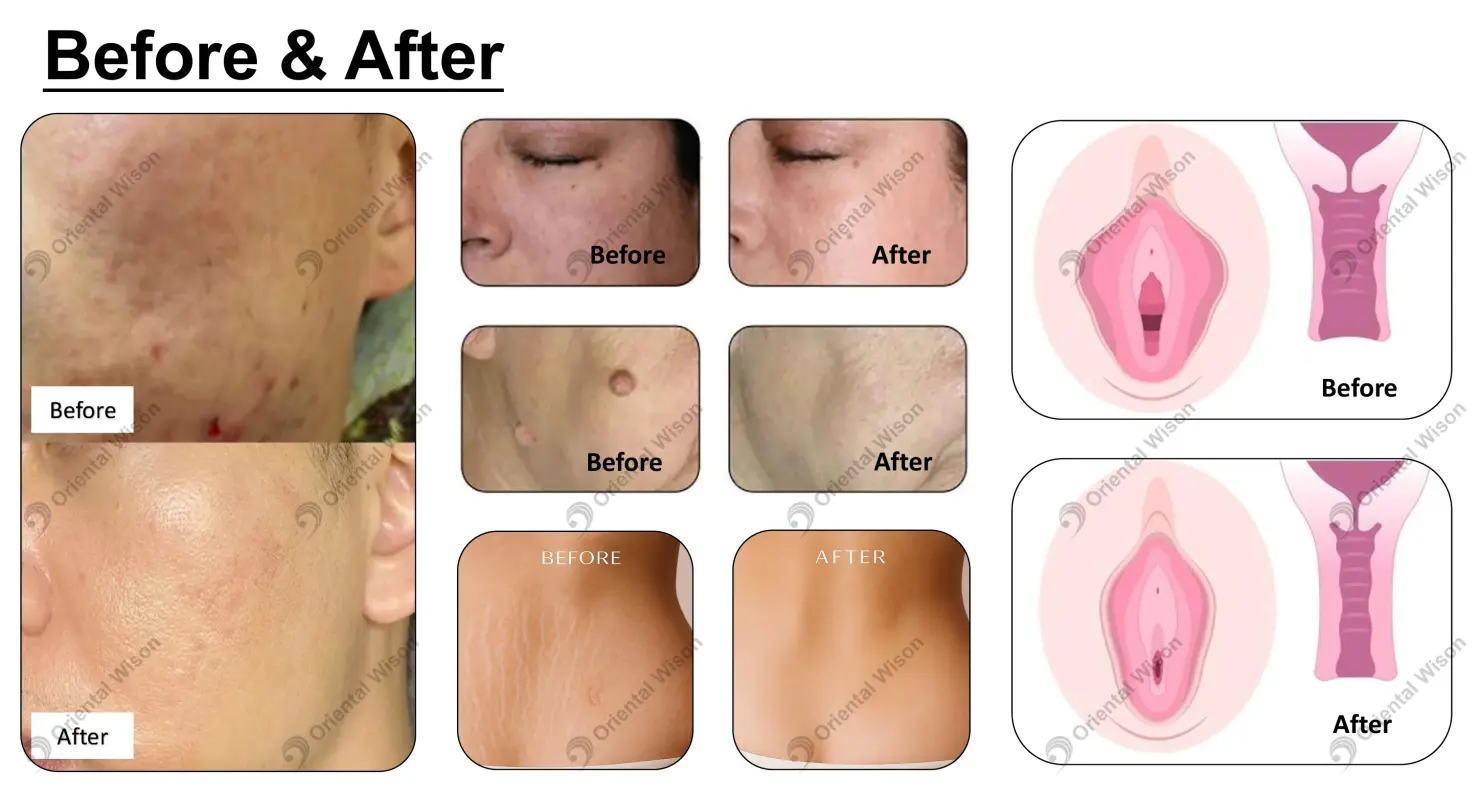 Spiral Co2 Laser Skin Resurfacing Machine